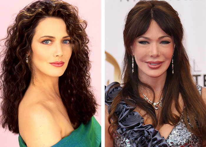 Celebrity before and after plastic surgery, highlighting unrecognizable transformation.