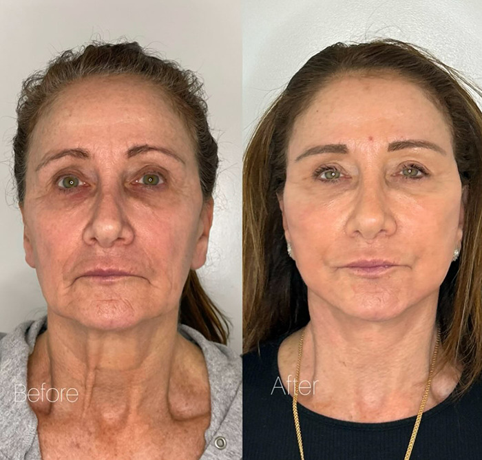 Before and after images showing woman's face treatment results.