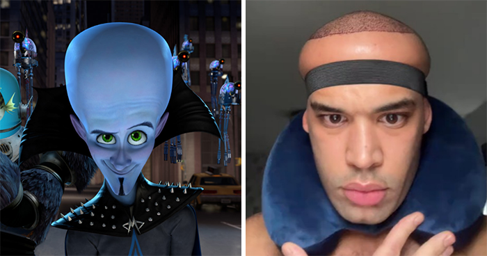 “Looking Crazy”: Man Gets Hair Transplant, Ends Up With Swollen “Megamind” Head