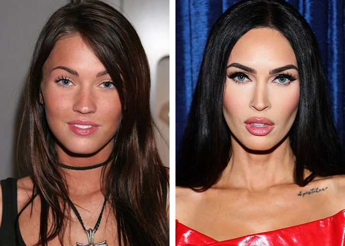 Two images showing plastic surgery transformation, highlighting changes in appearance.