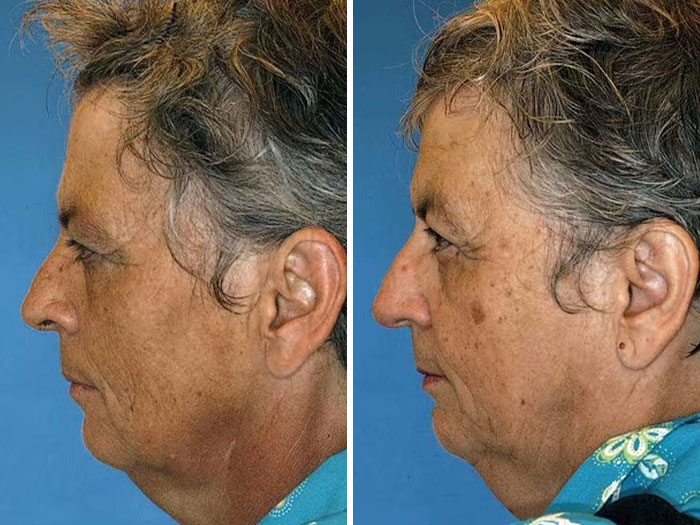 Twin study showing impact of divorce and diet on the face, side-by-side profile comparison with aging effects visible.
