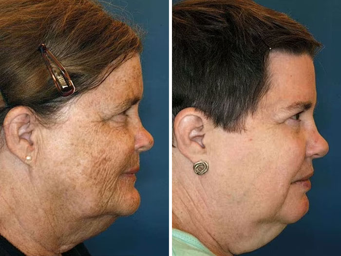 Twins study highlighting impact of divorce and diet on the face; two women in profile with different expressions.