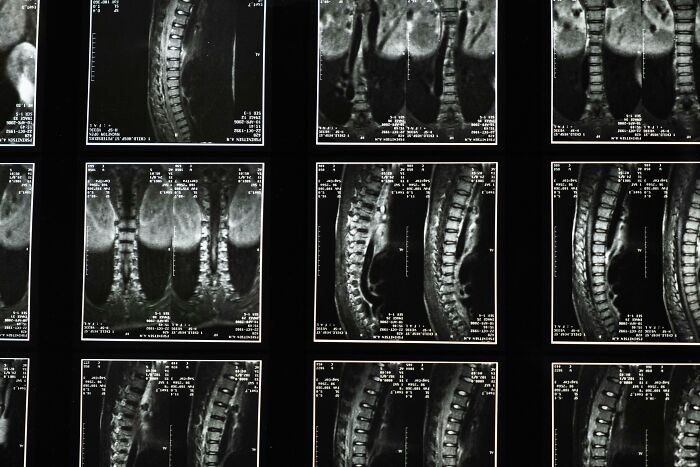 MRI scans showing spinal structures, illustrating genetic blessings and weaknesses in human anatomy.