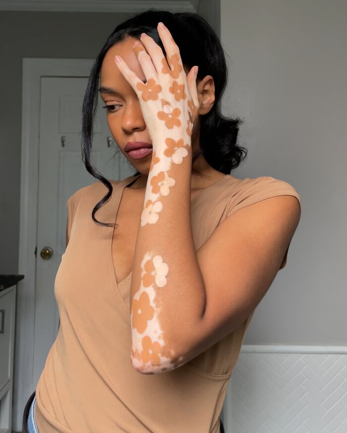 Woman with vitiligo showcasing beautiful body art on her arm, featuring floral designs, inspiring self-acceptance.