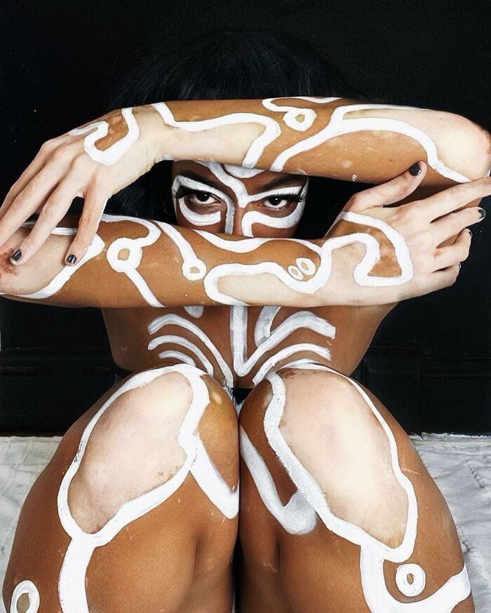 Artist transforms vitiligo into striking body art, showcasing creative self-acceptance with intricate white patterns.