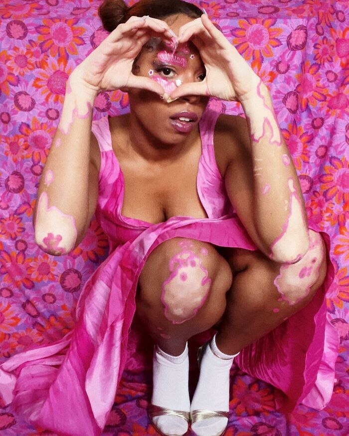 Artist showcasing vitiligo body art in a pink dress, making a heart shape with hands, promoting self-acceptance.