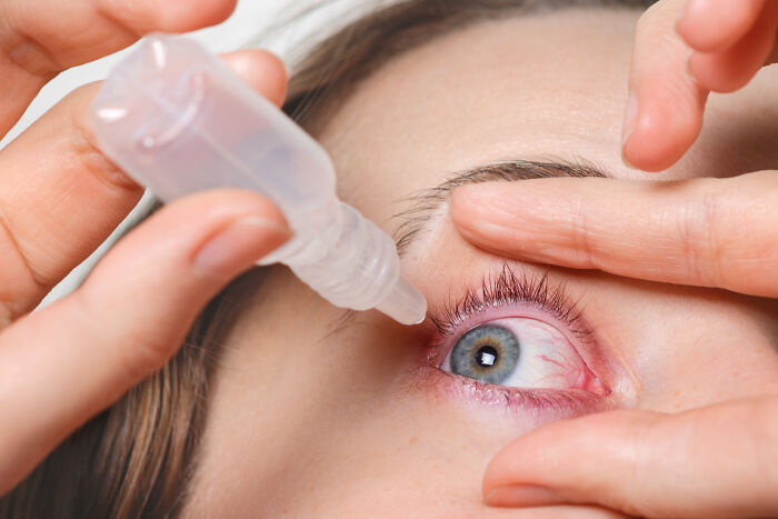 Person applying eye drops to alleviate irritation, focusing on eye care and health.