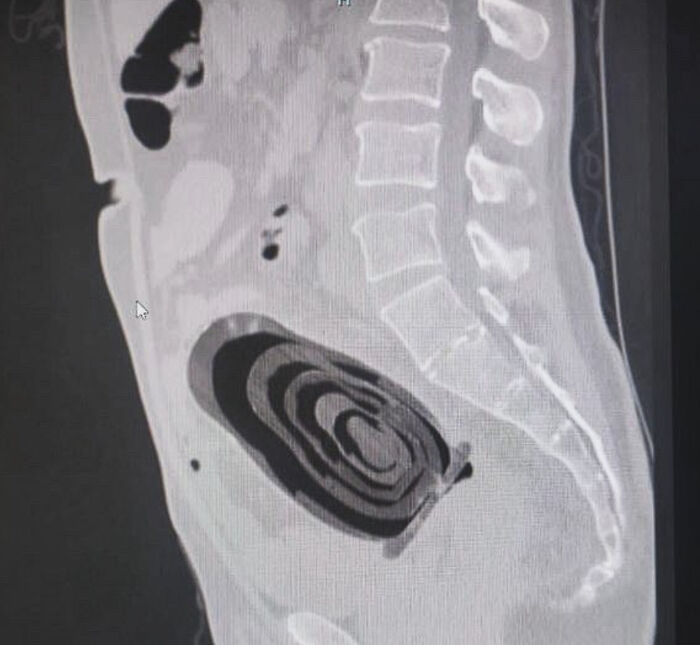 CT scan lateral view showing concentric circular foreign object in abdomen - medical pics