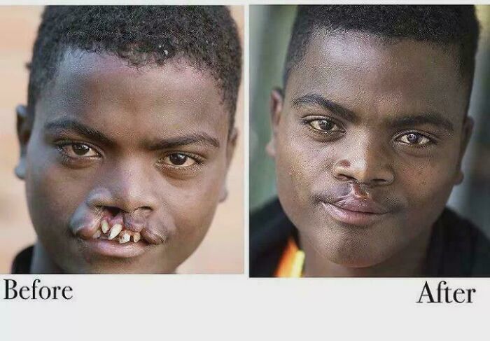 Before and after of a young man with cleft lip repaired via facial reconstructive surgery, medical pics