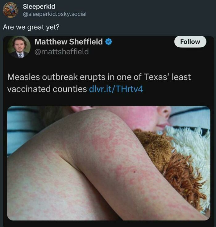 Measles outbreak in Texas child with rash, illustrating facepalm moments showing common sense is not common.