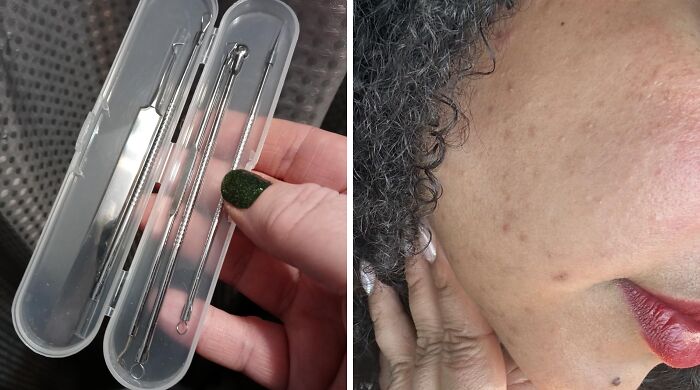 Skin care tool for blackhead removal held in hand next to close-up of skin with visible pores and blemishes, under $5.