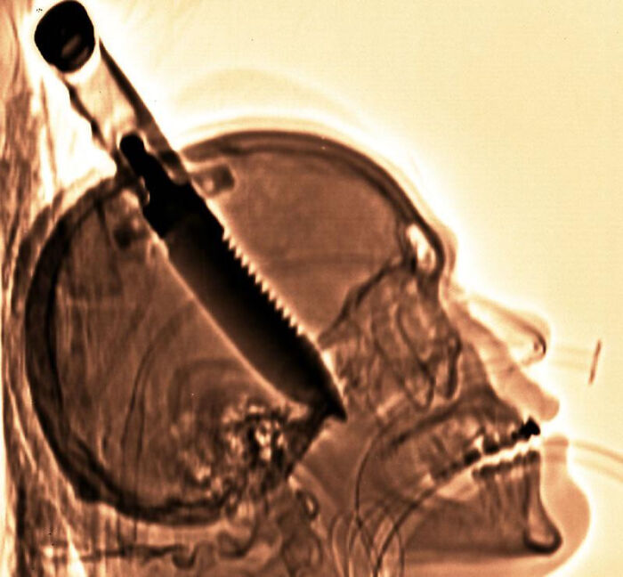 X-ray image of a bizarre situation with a large knife embedded in a human skull.