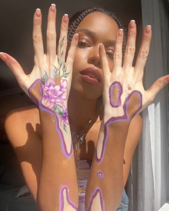 Artist turns vitiligo into stunning body art, highlighting her hands adorned with purple outlines and floral designs.
