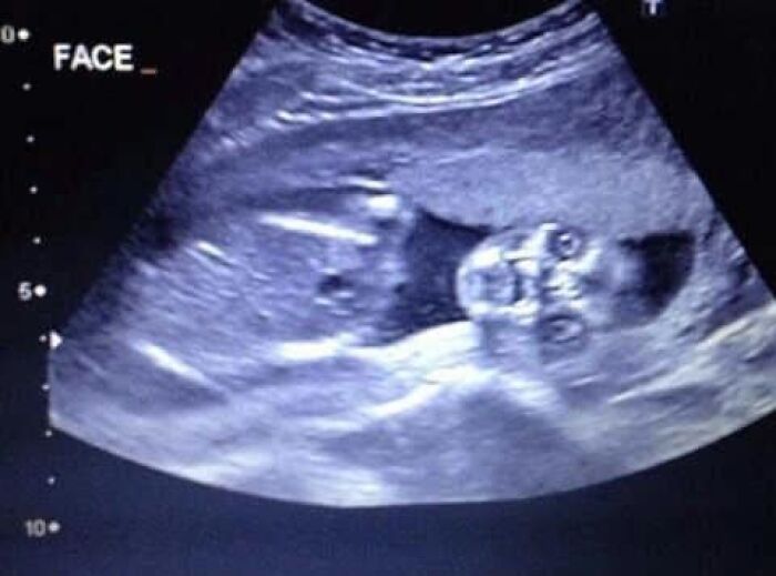 Ultrasound image showing an unusual shape, creating a weird visual impression worth seeing in various contexts.