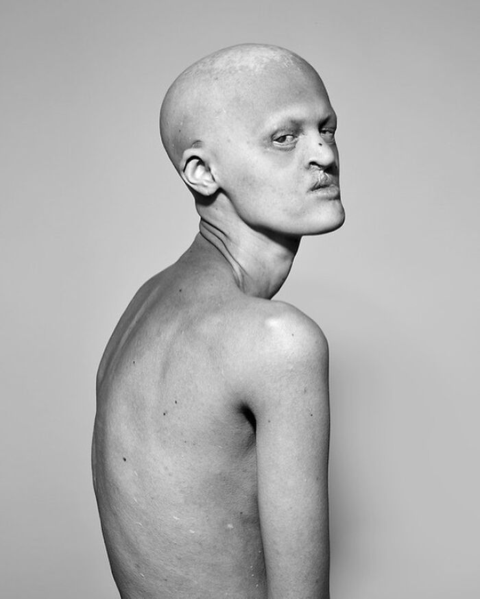 Unique model posing in a captivating black and white photograph, showcasing distinct features and expression.