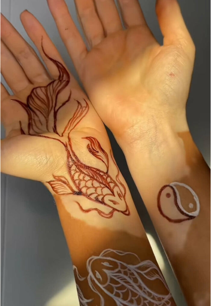 Vitiligo body art featuring a fish and yin yang symbol, highlighting beauty and self-acceptance.