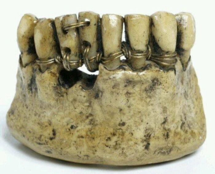 Ancient dental artifact showcasing early dental practices in civilizations.