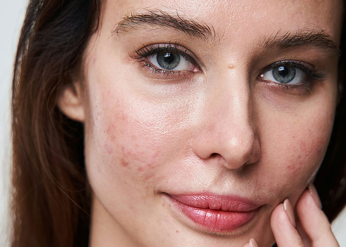 Close-up of a woman with acne-prone skin, showcasing attractive features.