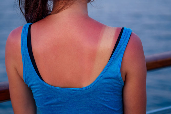 Back of a woman with sunburn lines, suggesting exposure under the Aussie sun without sunscreen.