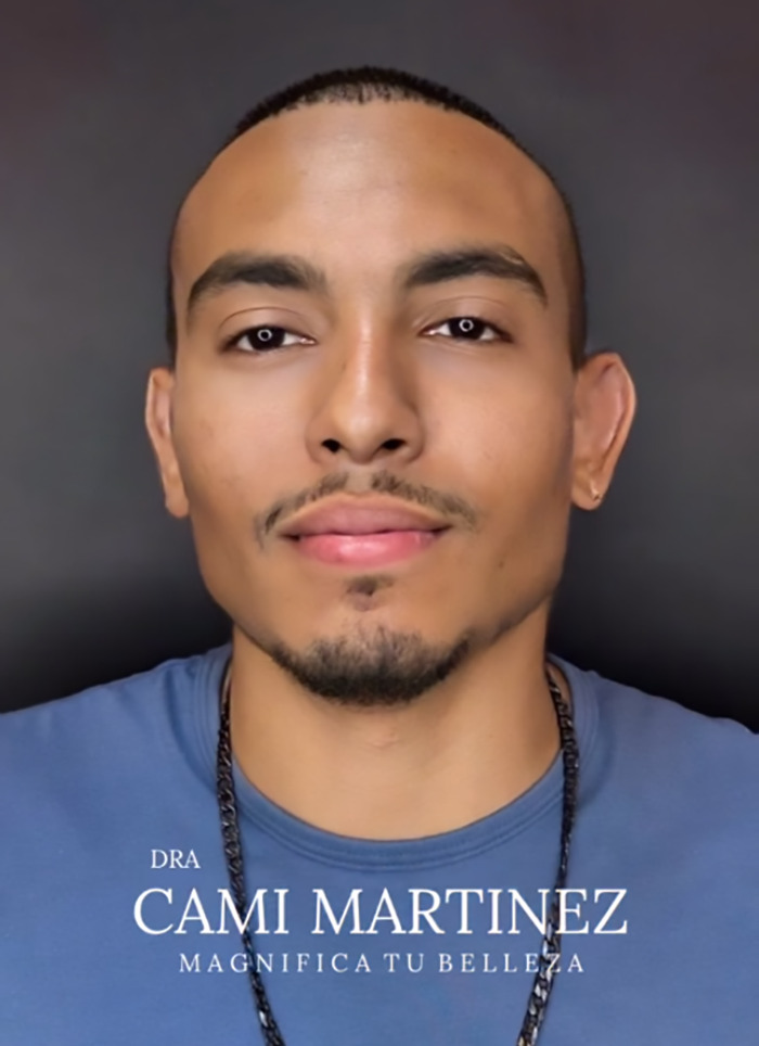 Man after plastic surgery, looking significantly younger, wearing a blue shirt against a dark background.