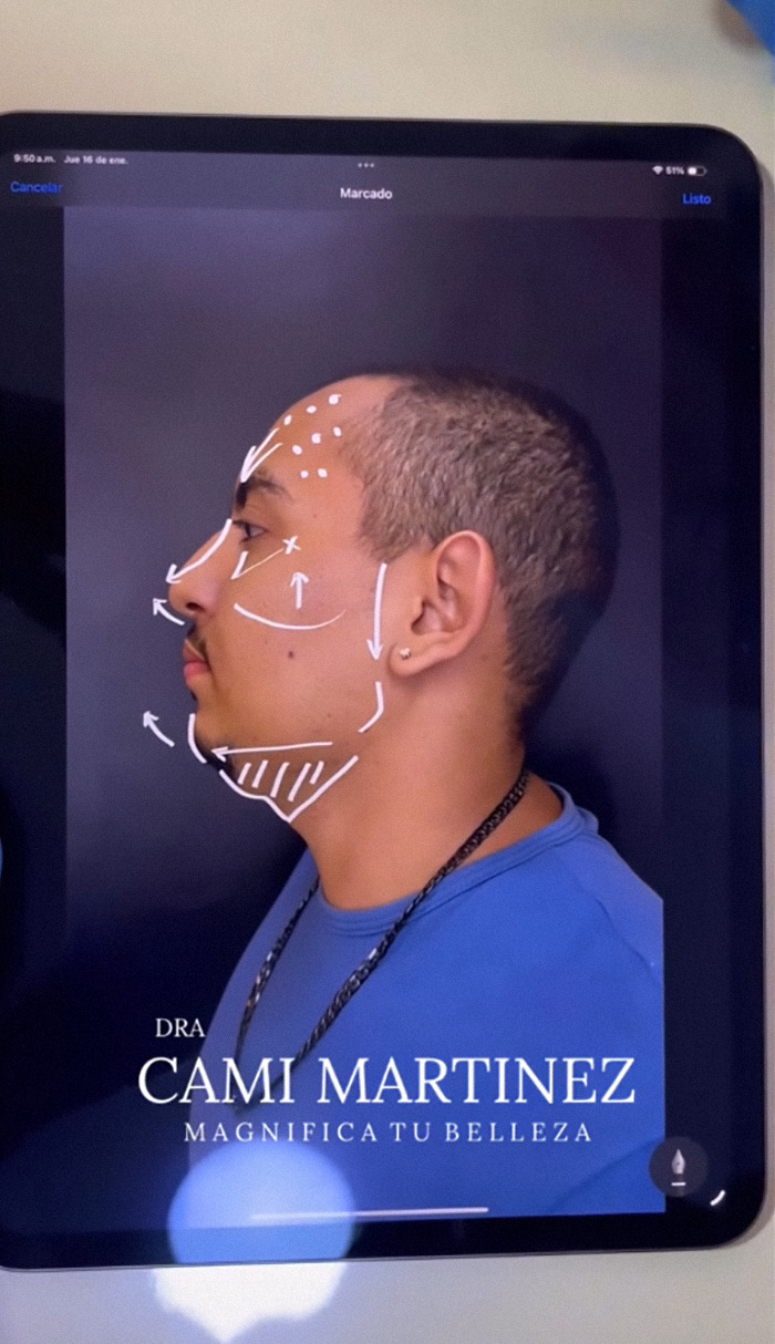 Man's plastic surgery markings on face, profile view, planning transformation.