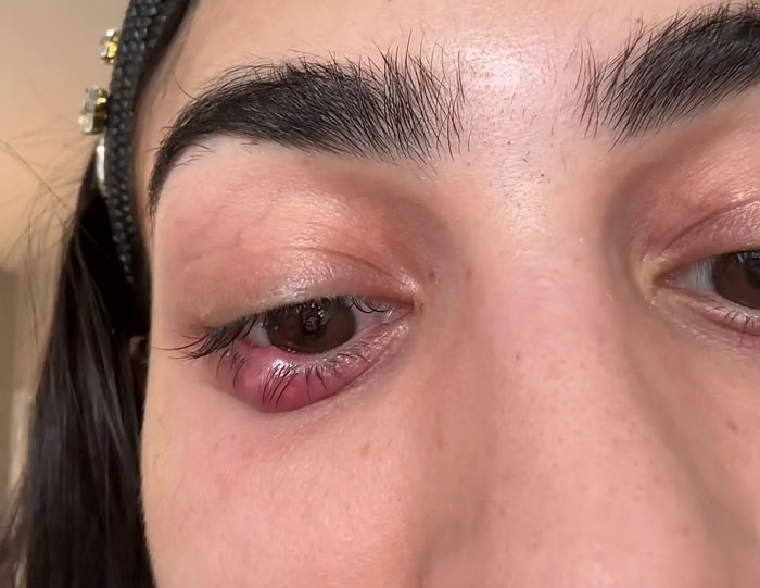 Close-up of a woman's eye showing a red infection, possibly from Sephora makeup testers. Close-up of a woman's eye showing a red infection, possibly from Sephora makeup testers.