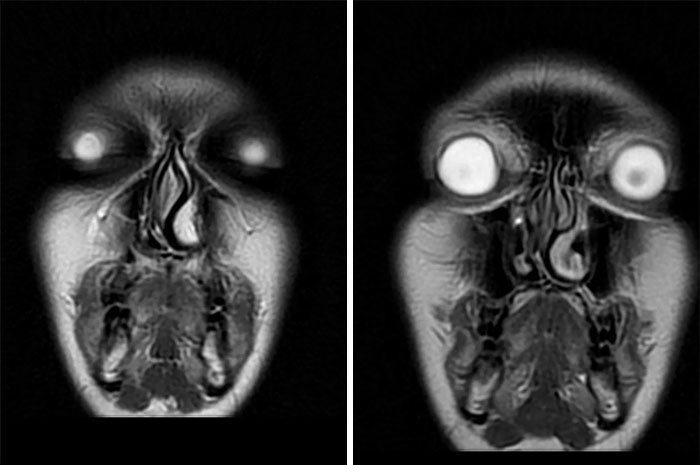 Dos imágenes extrañamente aterradoras de resonancia magnética, mostrando un rostro distorsionado y oscuro.