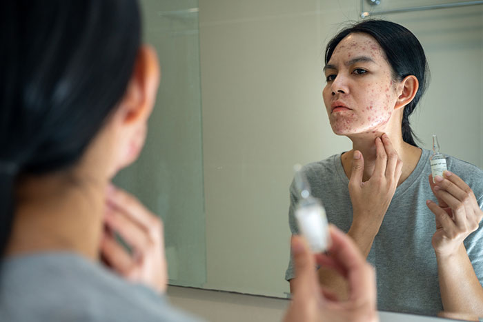 Student with acne examines face in mirror, holding skincare product, highlighting dermatological concerns in school setting.