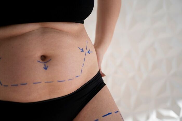 Marked areas on a woman's midsection indicating rare and unusual cosmetic procedures.