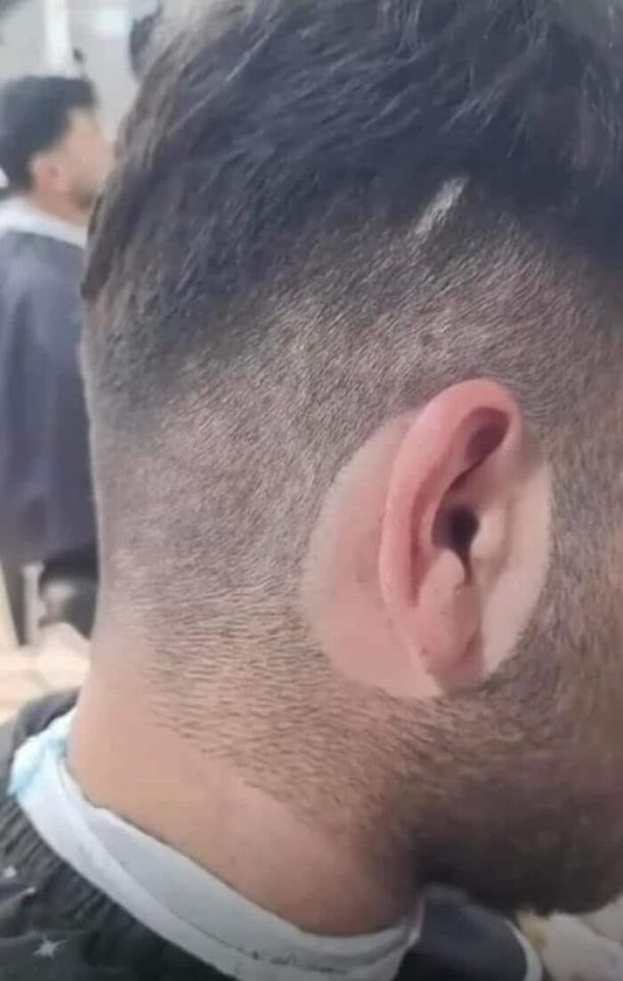 Close-up of a haircut with uneven and patchy shave, showcasing a hair fail.