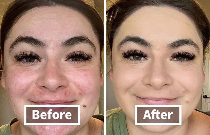 Before and after using popular beauty products showing improved skin clarity.