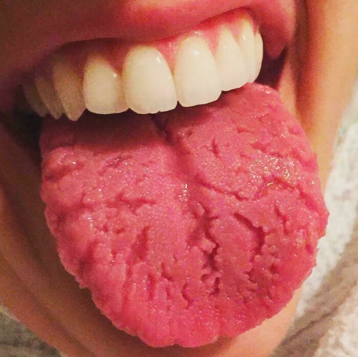 Lengua humana similar a carne molida, imagen para arruinarte el día.