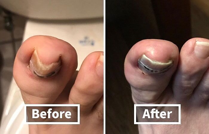 Before and after images of toenail treatment, suitable for discreet plain brown box delivery.