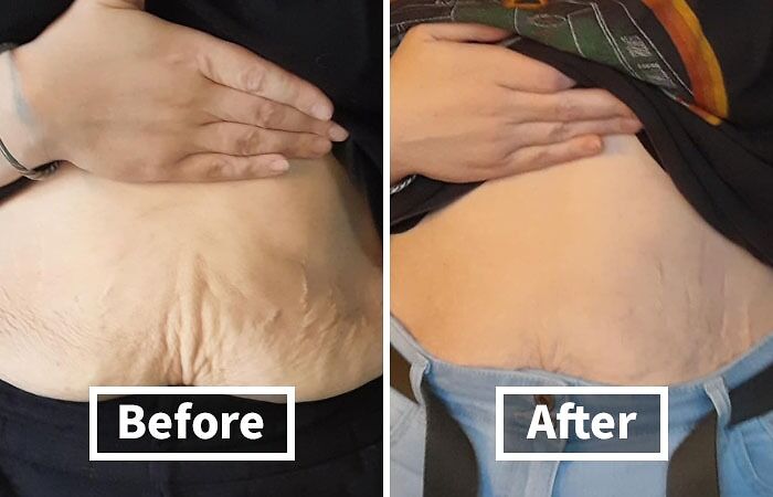 "Before and after results of beauty product use on skin with visible improvement."