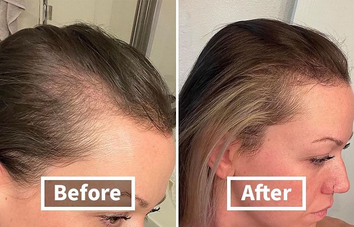 Before and after images showing results of popular beauty product for hair growth.