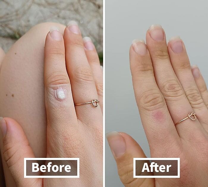 Before and after image of hand showing effects of a beauty product on skin blemish.