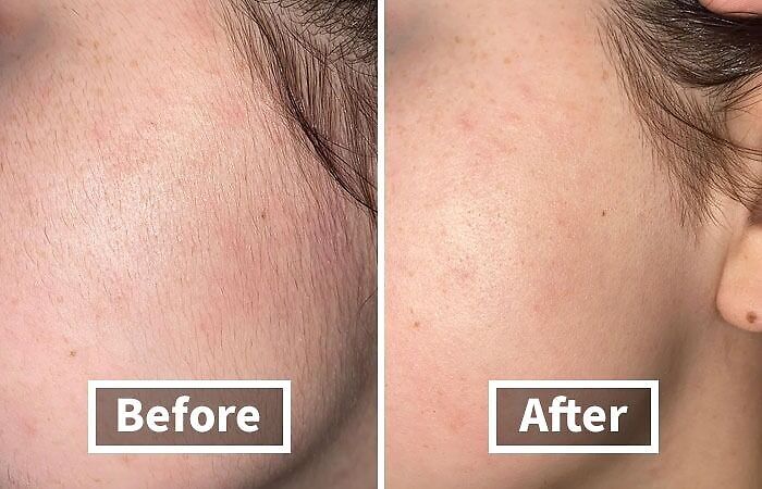 Before and after comparison showing skin improvement from beauty products.