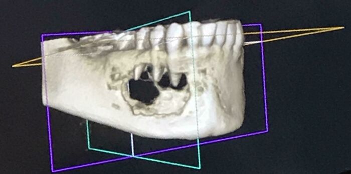 3D dental scan of a jaw with missing teeth, showcasing an intriguing aspect of our world's complexity.