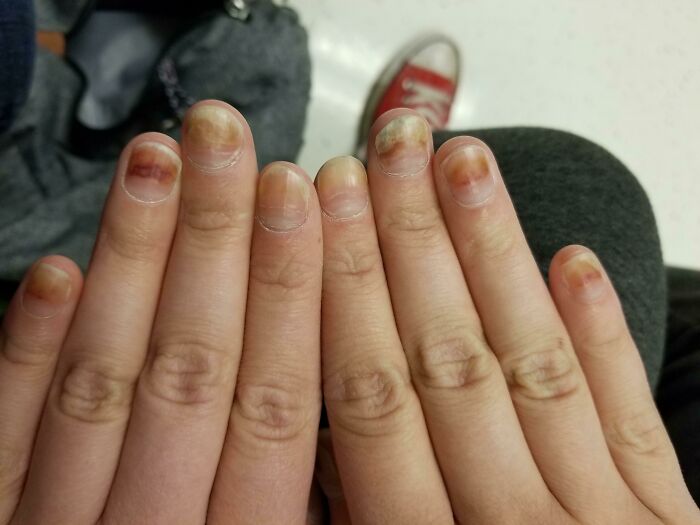 Close-up of unusual fingernails with discoloration, showing our world is far from boring.