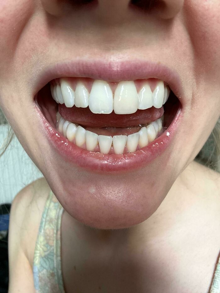 Close-up of a person smiling, showing their teeth, highlighting debates on beauty standards and trends.