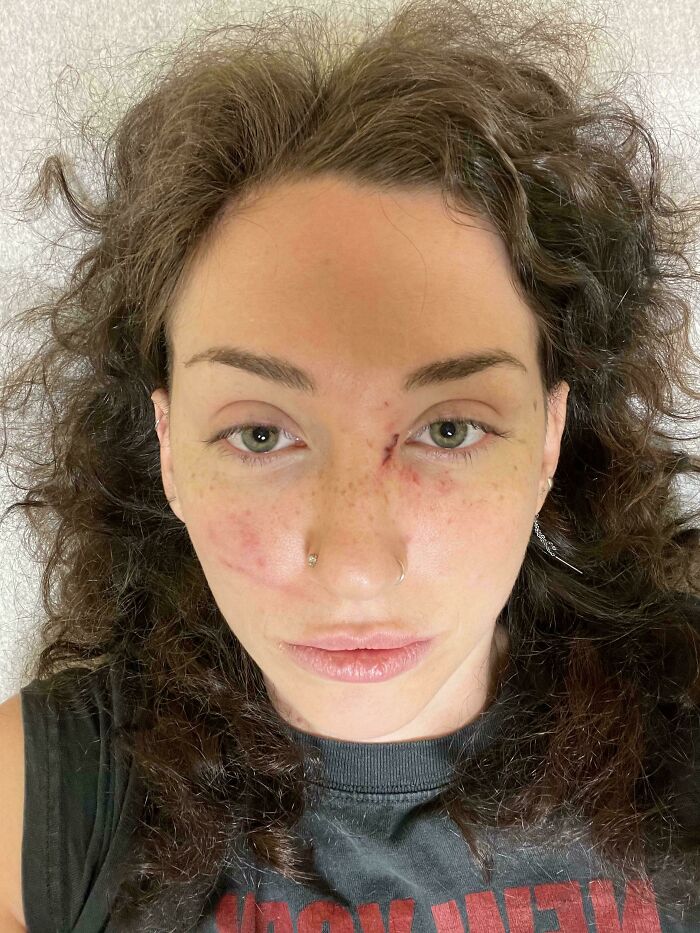 Woman with facial bruises and scratches, frizzy hair, and a nose piercing, experiencing a horrible day.