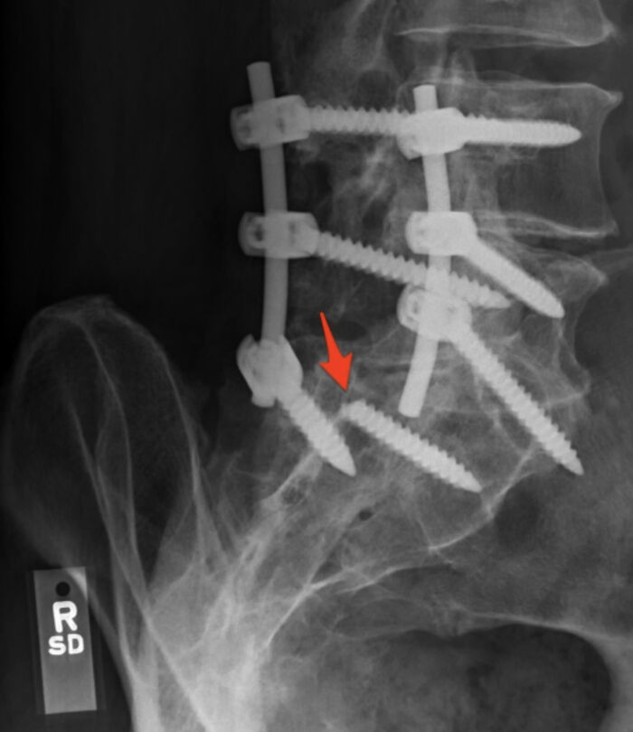 An X-ray showing multiple screws in the spine, highlighting a severe back injury.