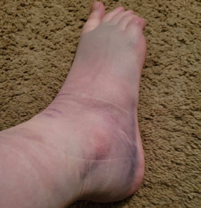 Swollen, bruised ankle indicating a difficult day compared to others.
