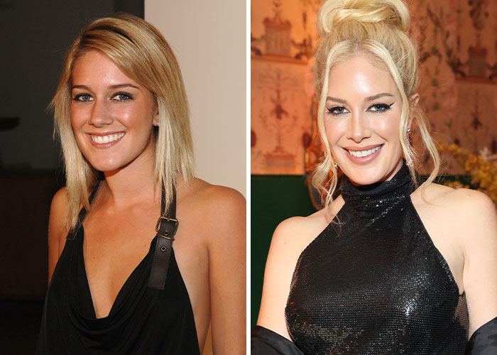 Two images side by side of a celebrity before and after plastic surgery changes.