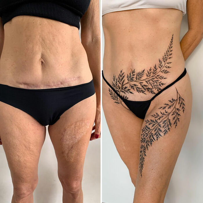 Before and after of a transformational tattoo covering scars with elegant floral design, enhancing confidence.