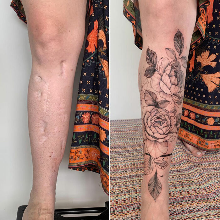 Leg scar transformed into floral tattoo, showcasing art that reclaims confidence.