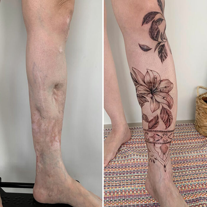 Scar transformed into beautiful floral tattoo on leg, showcasing artistic confidence.