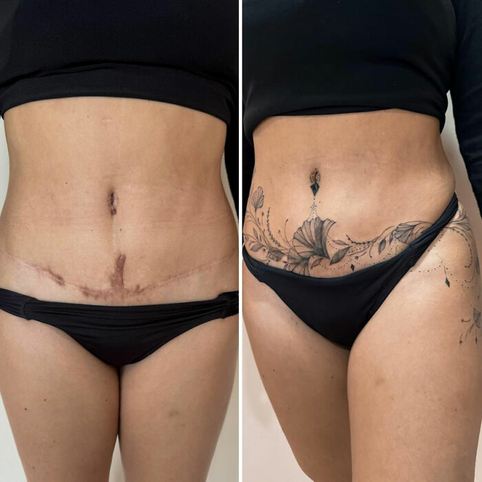 Scar transformed into beautiful floral tattoo on woman's abdomen, showcasing artistic confidence reclaim.