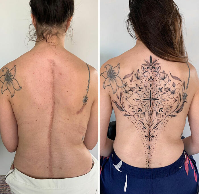 Person's back with scar transformed into beautiful floral tattoo, showcasing tattoo art's impact on confidence.