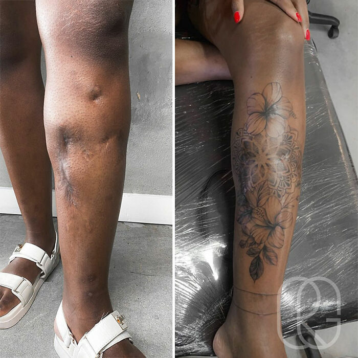 Leg with scars transformed into beautiful floral tattoo, highlighting confidence and artistry.